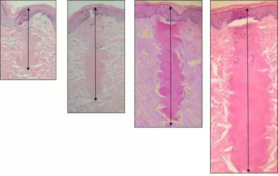 激光祛疤的利弊大揭秘,激光祛疤的原理和方法