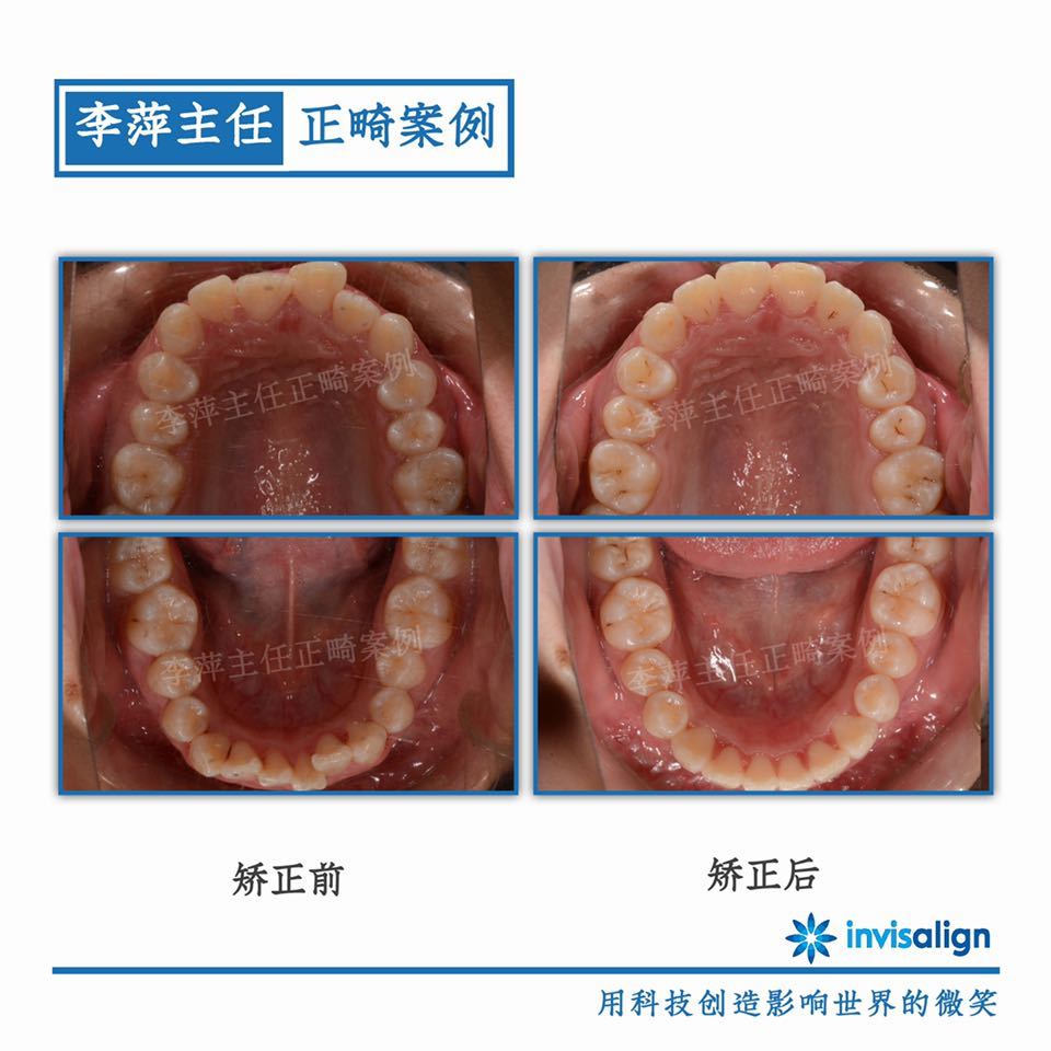 太原隐形牙齿矫正哪家靠谱,太原李萍正畸怎么样