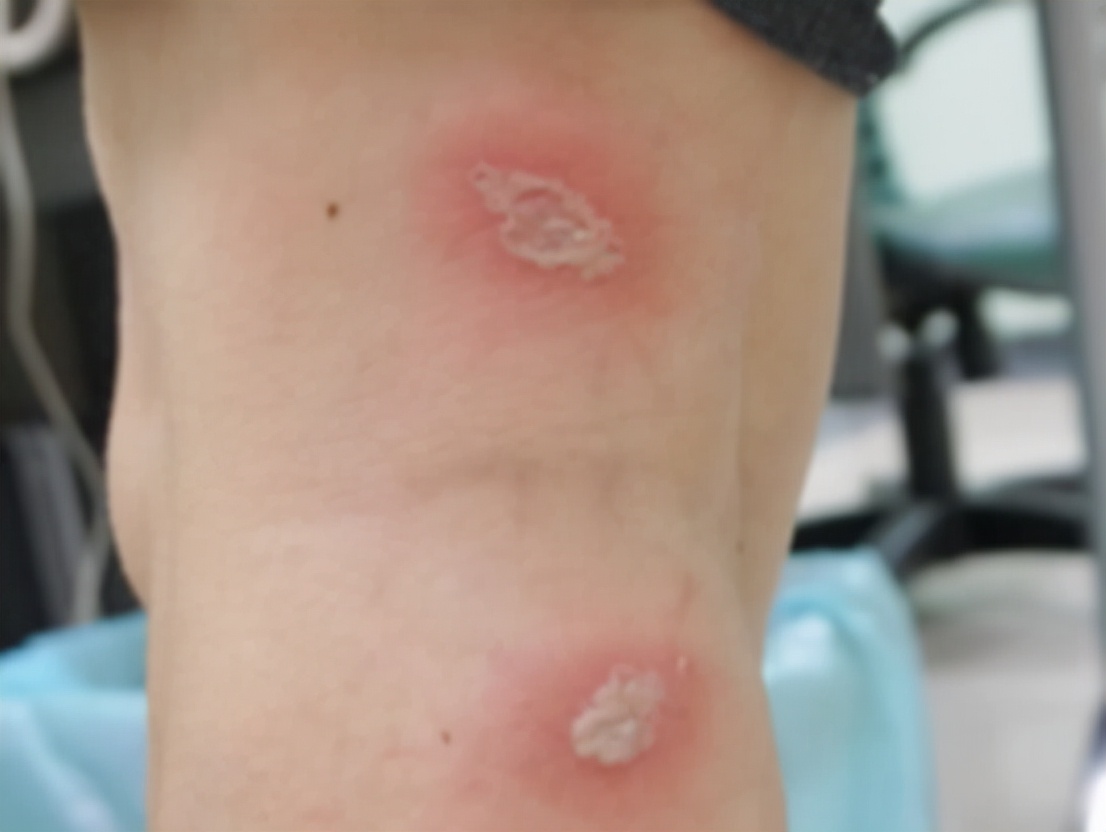 被隐翅虫咬伤有多可怕,被隐翅虫咬后症状图片及治疗方法