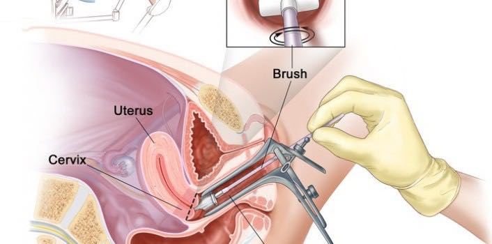 体检每次都查的HPV，你真的正确对待了吗？