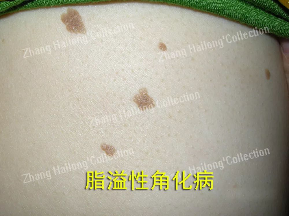 Ohno！老妈脸上出现了老年斑...