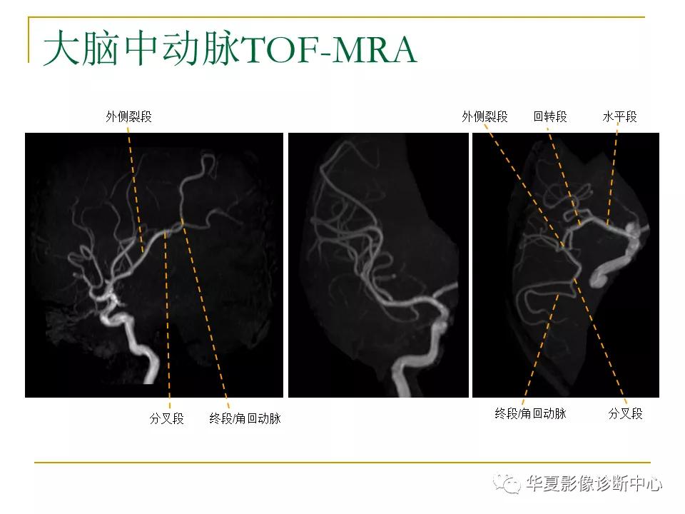 中国人脑立体定向mri应用解剖图谱,脑mri示意图