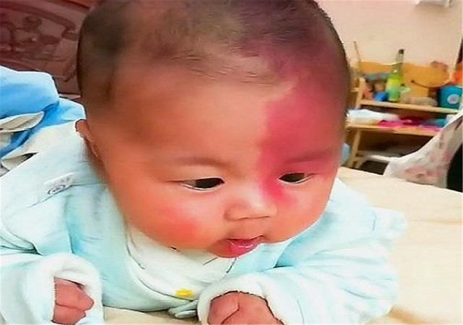 胎儿长胎记是怎么导致的,胎儿容易长胎记的原因是什么