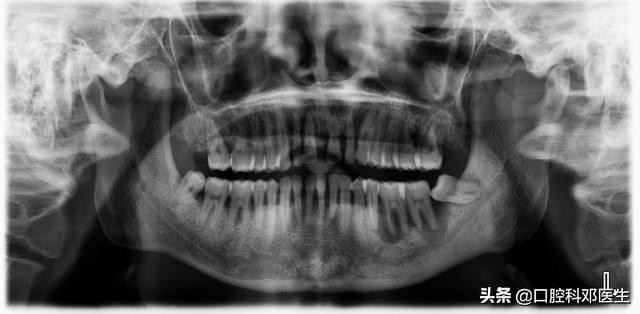 牙周炎导致门牙缝隙大,牙周炎引起门牙缝隙变大