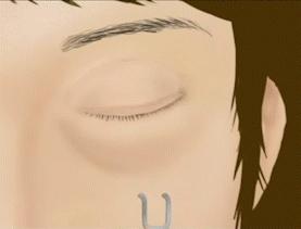 泪沟都到脸颊了怎么办,泪沟眼袋越来越严重怎么办