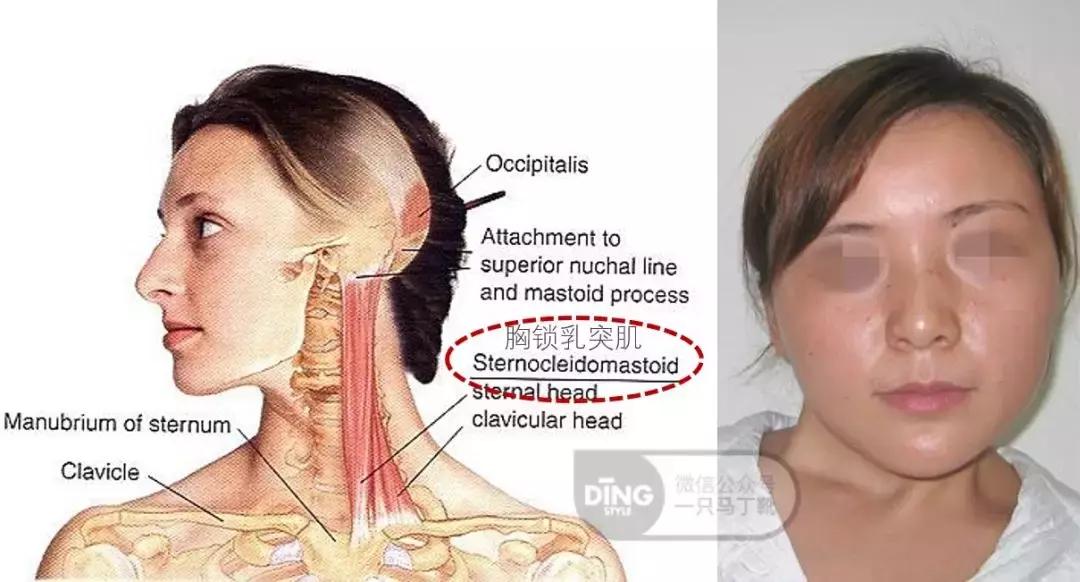 脸大小不对称怎么矫正,如何改善大小脸不对称