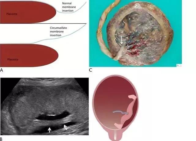 临床上最常见的异常胎盘,前置胎盘和低置胎盘超声