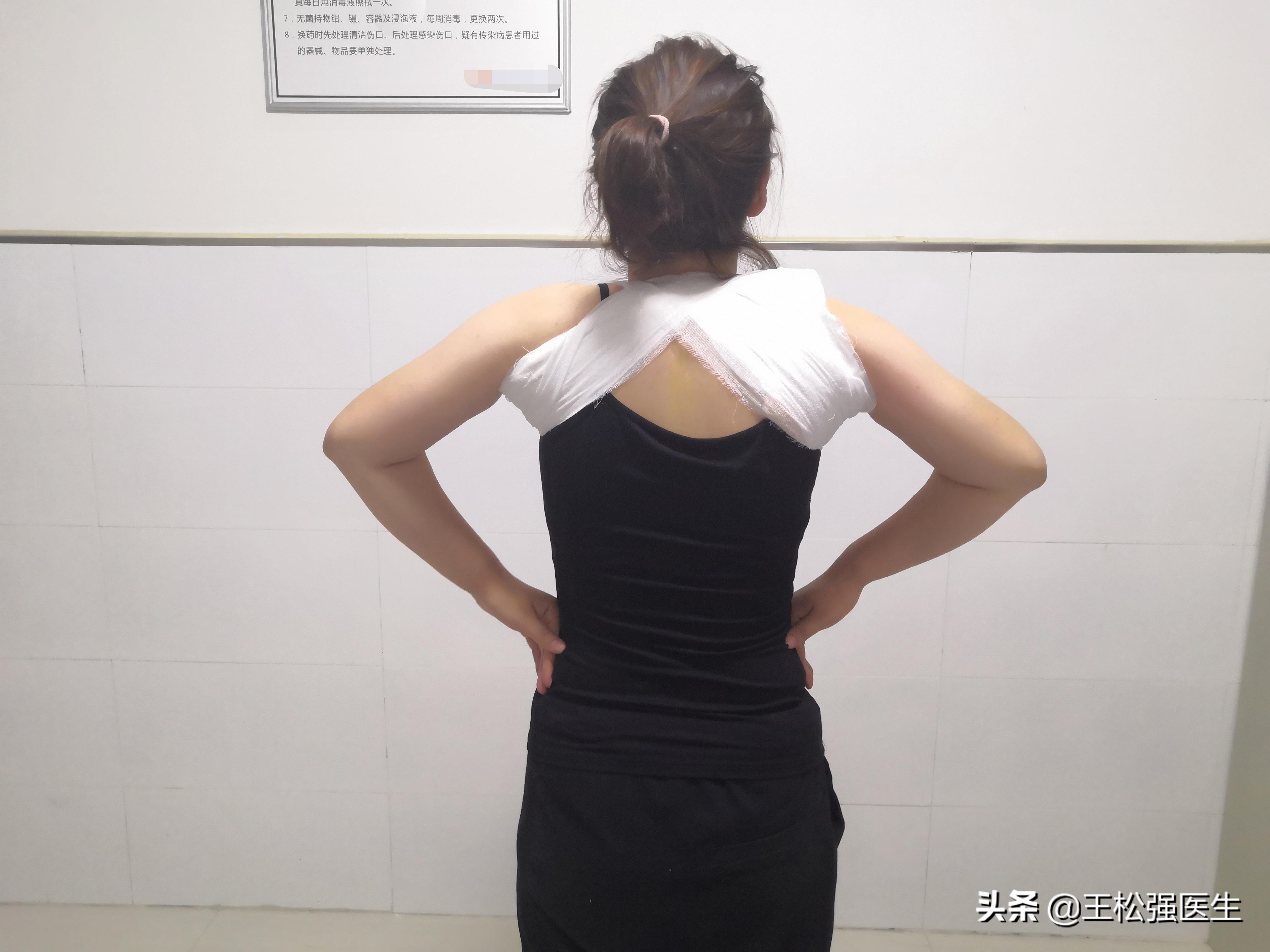 锁骨中段骨折保守治疗注意事项,儿童锁骨骨折怎么办