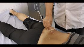 腰椎间盘突出引起的腰腿痛，针灸如何取穴？如何治疗？效果好