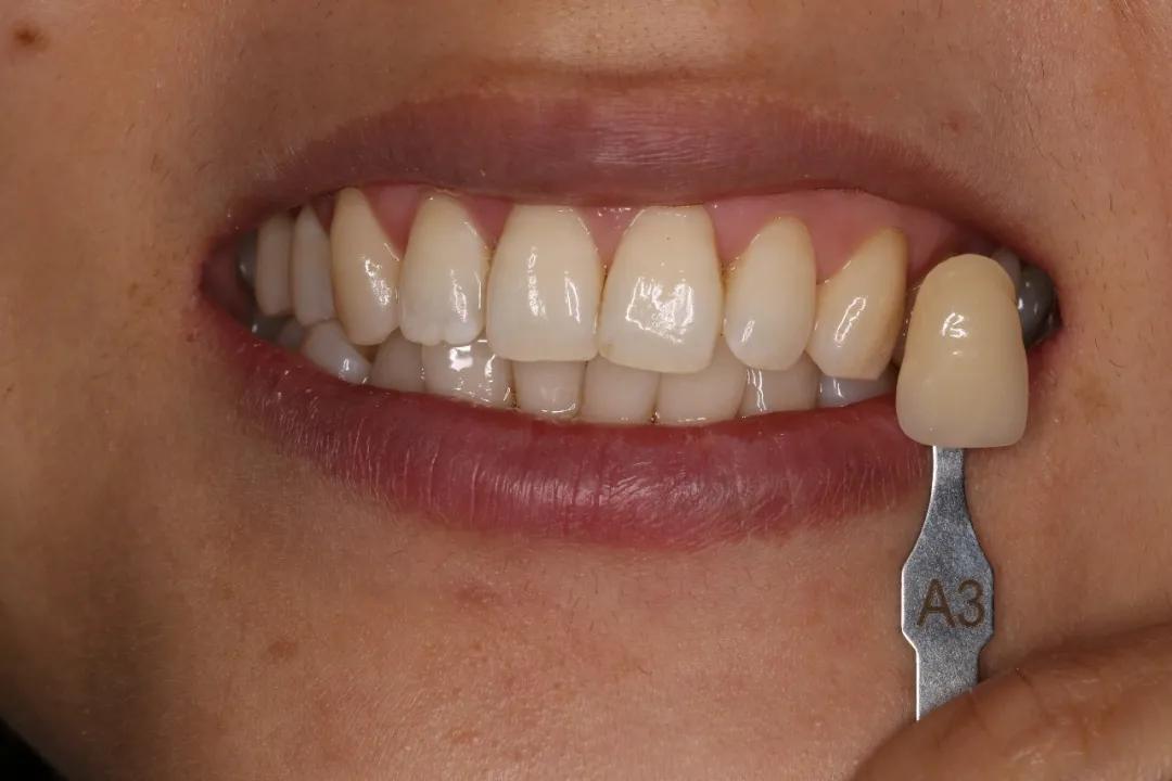 牙齿美白这个行业靠谱吗,柠檬美白牙齿靠谱吗