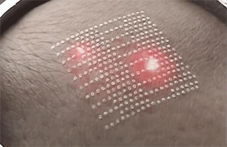 痘印痘坑目前治疗方法哪个最好,医美机构靠药物去痘印痘坑可靠吗