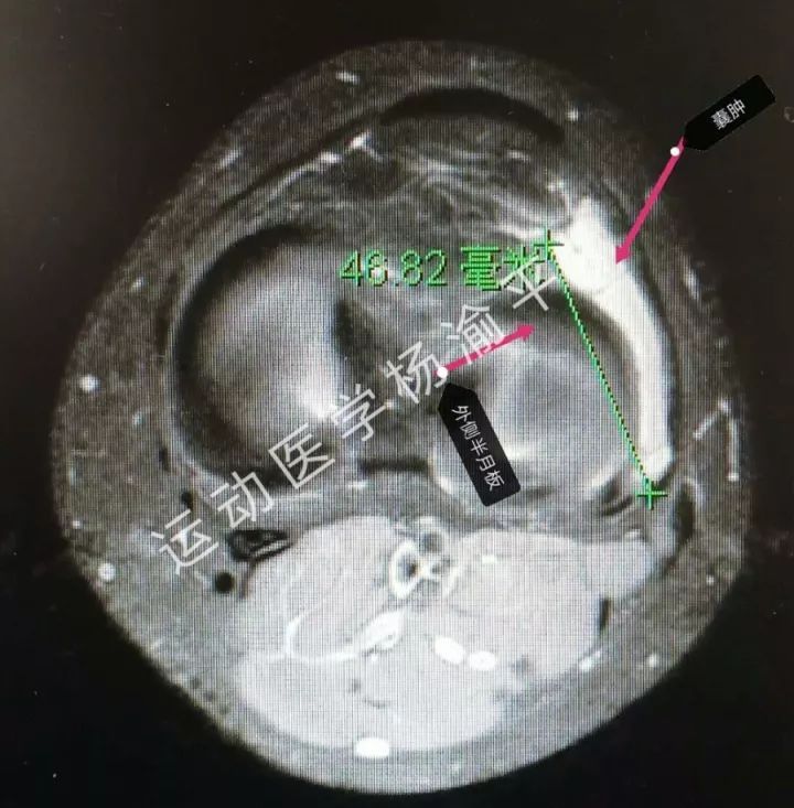 半月板缝合有必要切除滑膜吗,半月板缝合和半月板切除哪个严重