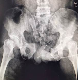 北京积水潭骨折修复,北京积水潭治疗陈旧骨盆骨折