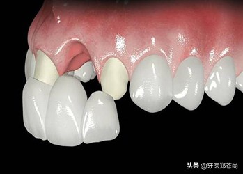 牙齿缺损除了补牙还能补吗,牙齿缺了半边能补牙带牙套吗