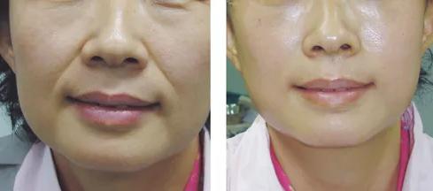 法令纹怎样淡化效果最好,有法令纹了怎么改善真实有效