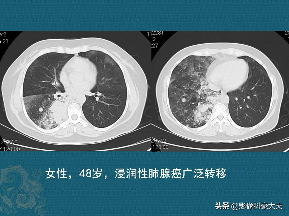 昂贵靶向药有必要吗,昂贵的靶向药真的好吗