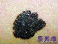皮下出现黑点是色素痣吗,慢慢长很多色素痣是为什么