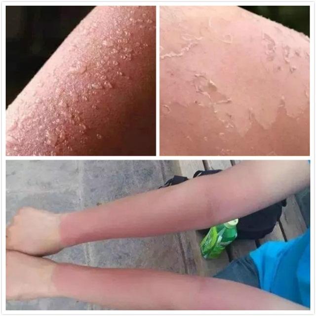 军训防晒护肤全套流程,军训晒黑急救护肤