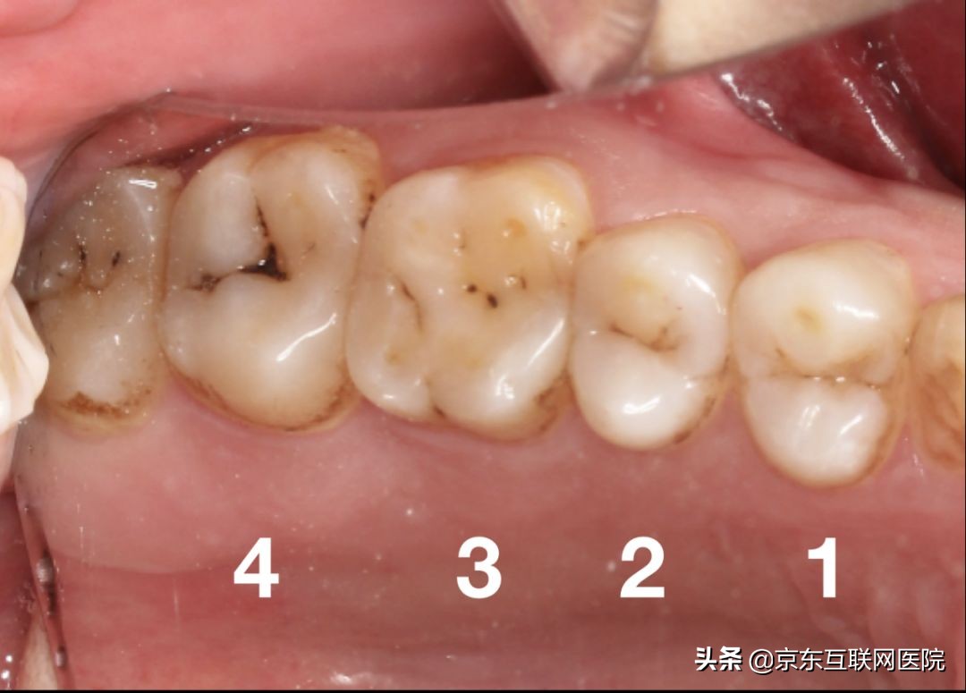 牙齿上面有黑线补牙怎么弄,牙齿有严重黑线怎么补牙