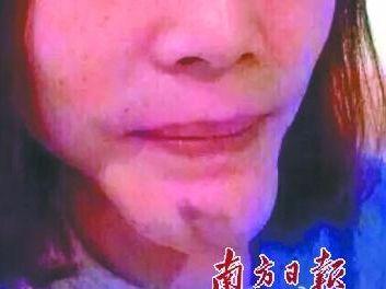 张歆艺用的什么填充脸部,张歆艺填充脸部前后对比