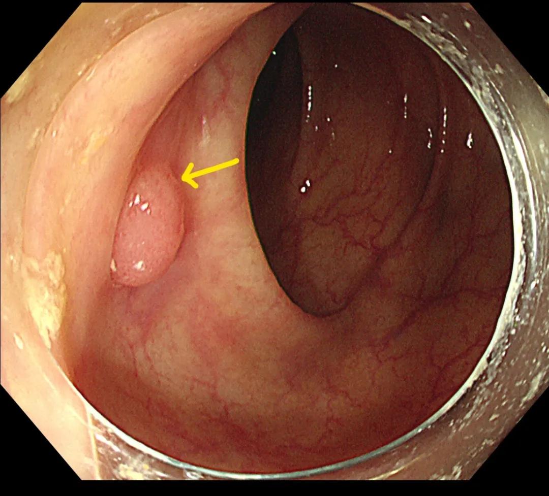 内镜逆行阑尾炎治疗术适应症,急性阑尾炎中西医结合内镜下治疗