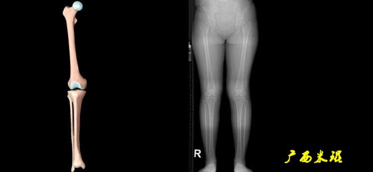 广西骨科医生米琨最新信息,米琨广西骨科什么水平