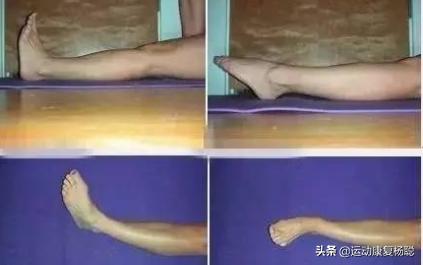 踝关节内外髁骨折一般有后遗症吗,踝关节骨折后遗症的症状