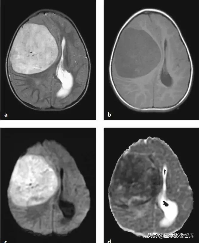 双侧额叶皮层区dwi偏高是什么意思,颅内dwi高信号病变