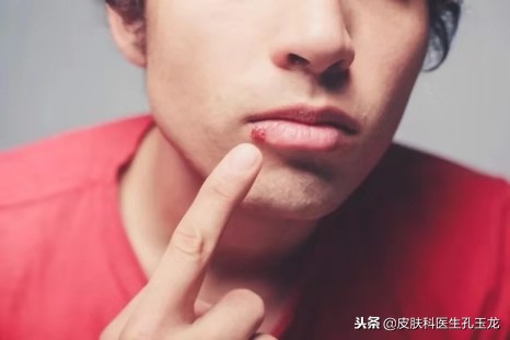 皮肤科单纯疱疹专家,上火嘴上起的疱疹什么原因