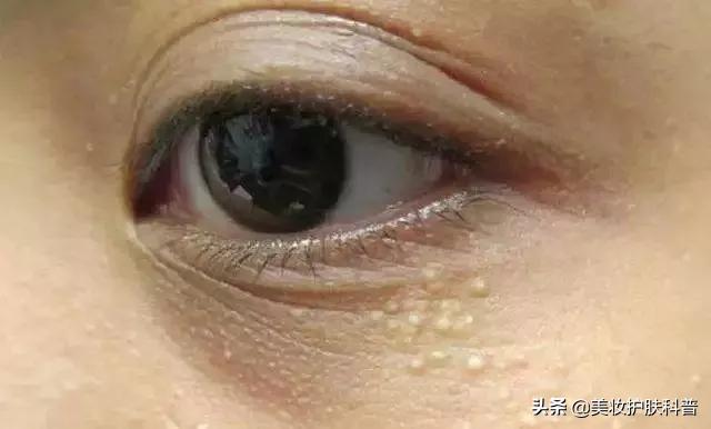 眼周长脂肪粒了怎么办,眼周长脂肪粒怎么处理