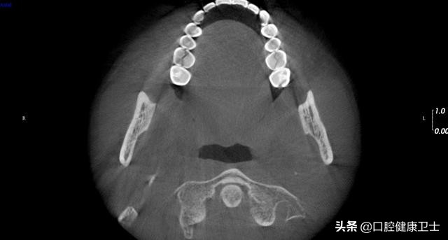 牙齿劈裂怎么处理,牙齿劈裂的补救方法