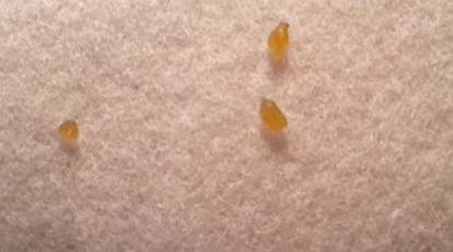 抿嘴上嘴唇很多白色颗粒怎么消除,抿嘴时下嘴有小颗粒是怎么回事