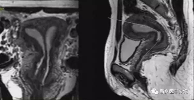 子宫发育异常，应想到的6大类常见畸形