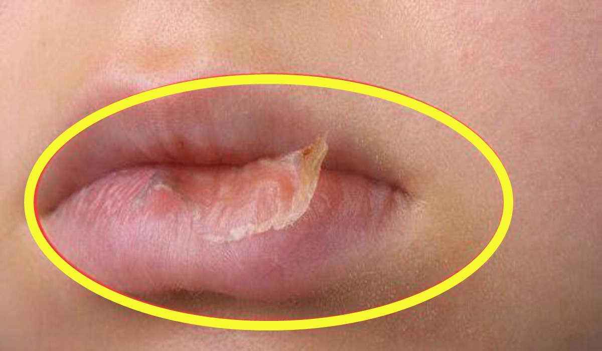 孩子嘴唇干裂起皮怎么快速解决,喝水多但嘴巴干裂起皮什么原因