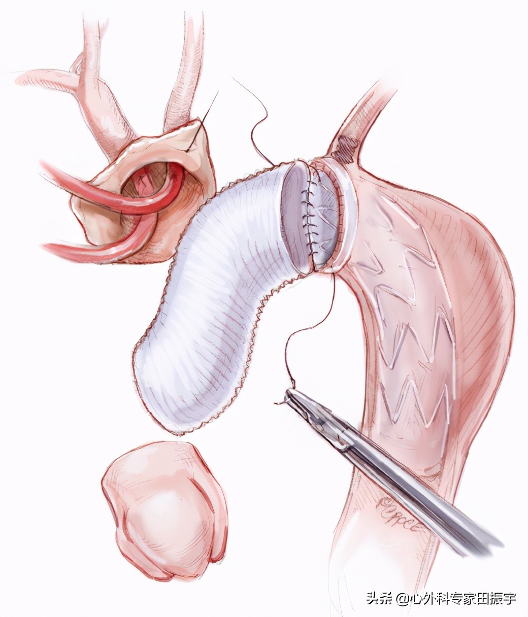 主动脉夹层破裂的院前急救,主动脉夹层破裂的临床表现和处理