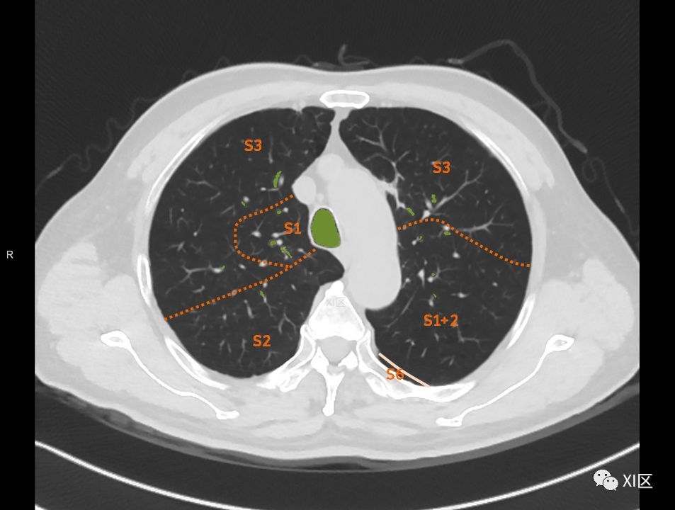 如此详细的肺部影像解剖，有点儿酷