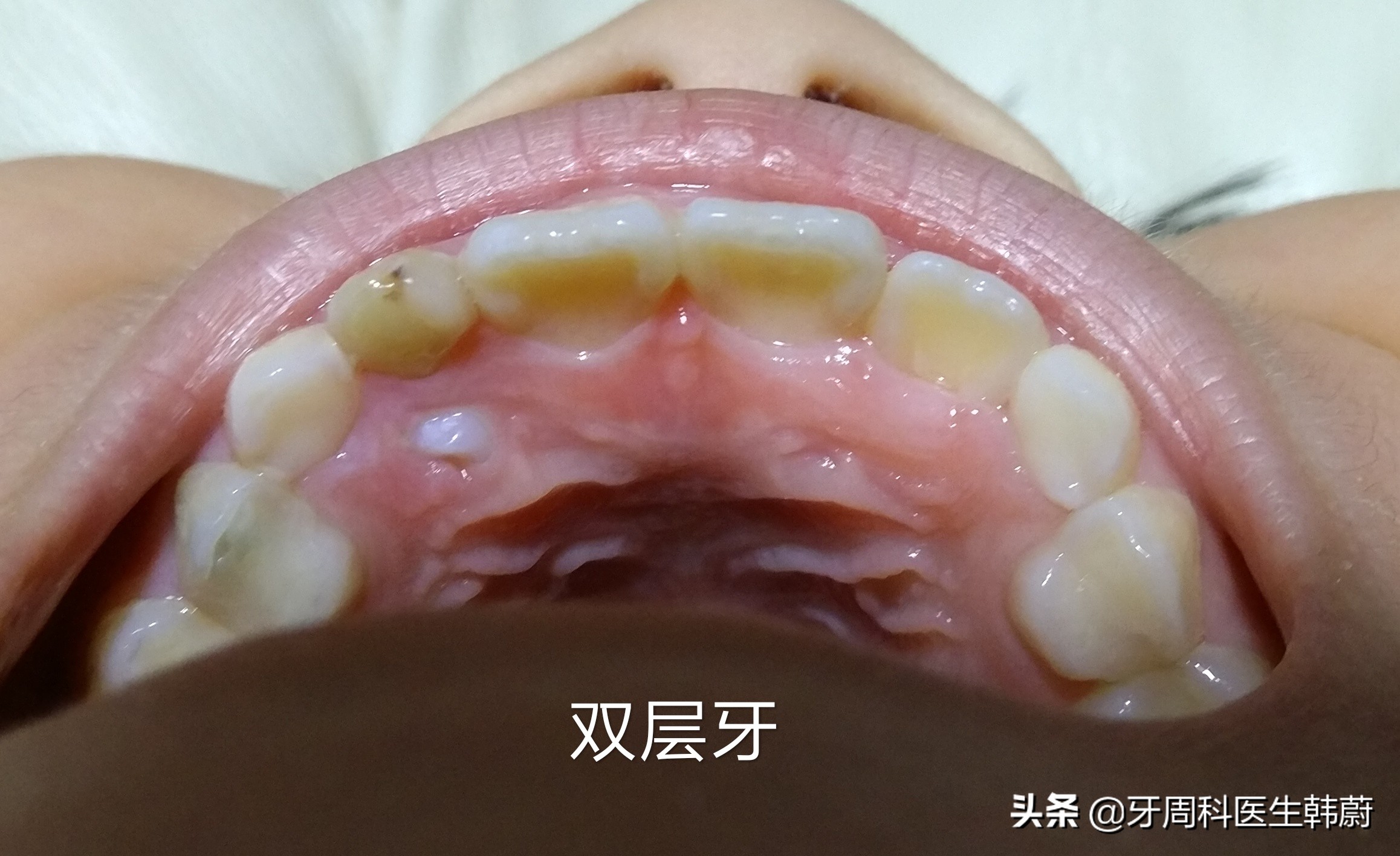 宝宝长双层牙乳牙怎么拔掉,6岁小孩长双层牙必须拔掉吗