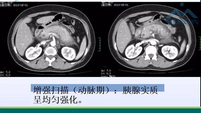 急性胰腺炎的护理措施,急性胰腺炎影像与临床