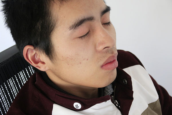 脸上长疮化脓怎么办,脸上长疮疤怎么去除