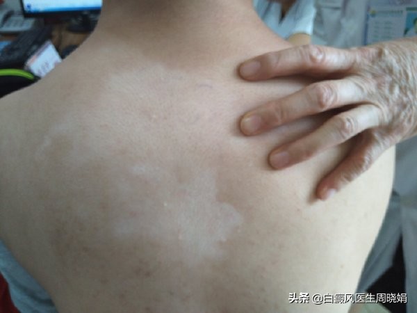 脸上的白斑长得好快是什么原因,脸上有不规则的白斑是什么