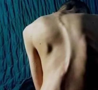 强直性脊柱炎严重的后果,儿童强直性脊柱炎早期最典型症状