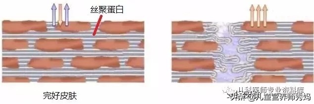 宝宝湿疹怎么办？实践证明这样处理最有效