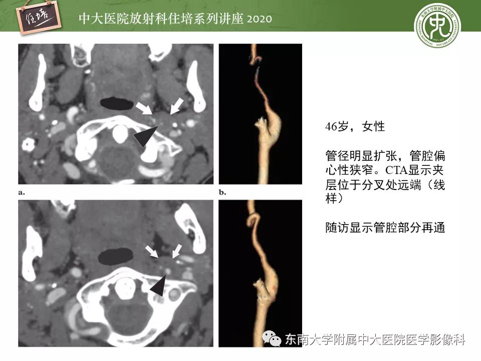 颈动脉夹层的超声表现及漏诊分析,动脉夹层与夹层动脉瘤是一样的吗