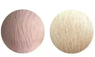 因肥胖撑出的纹怎么去除,因为肥胖导致的胖纹怎么消掉