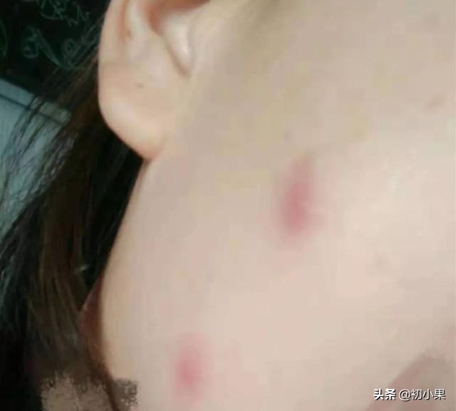 居家旅行必备的战痘攻略