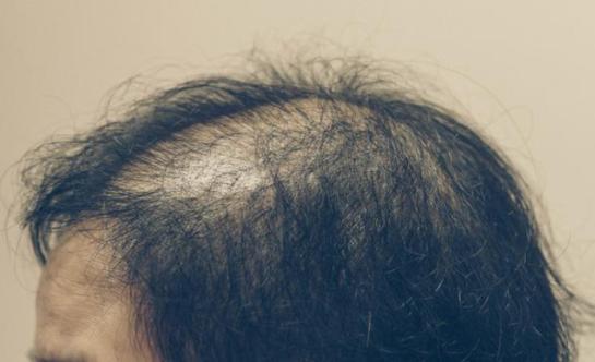 南昌市第12医院植发科,南昌第12医院植发效果怎么样