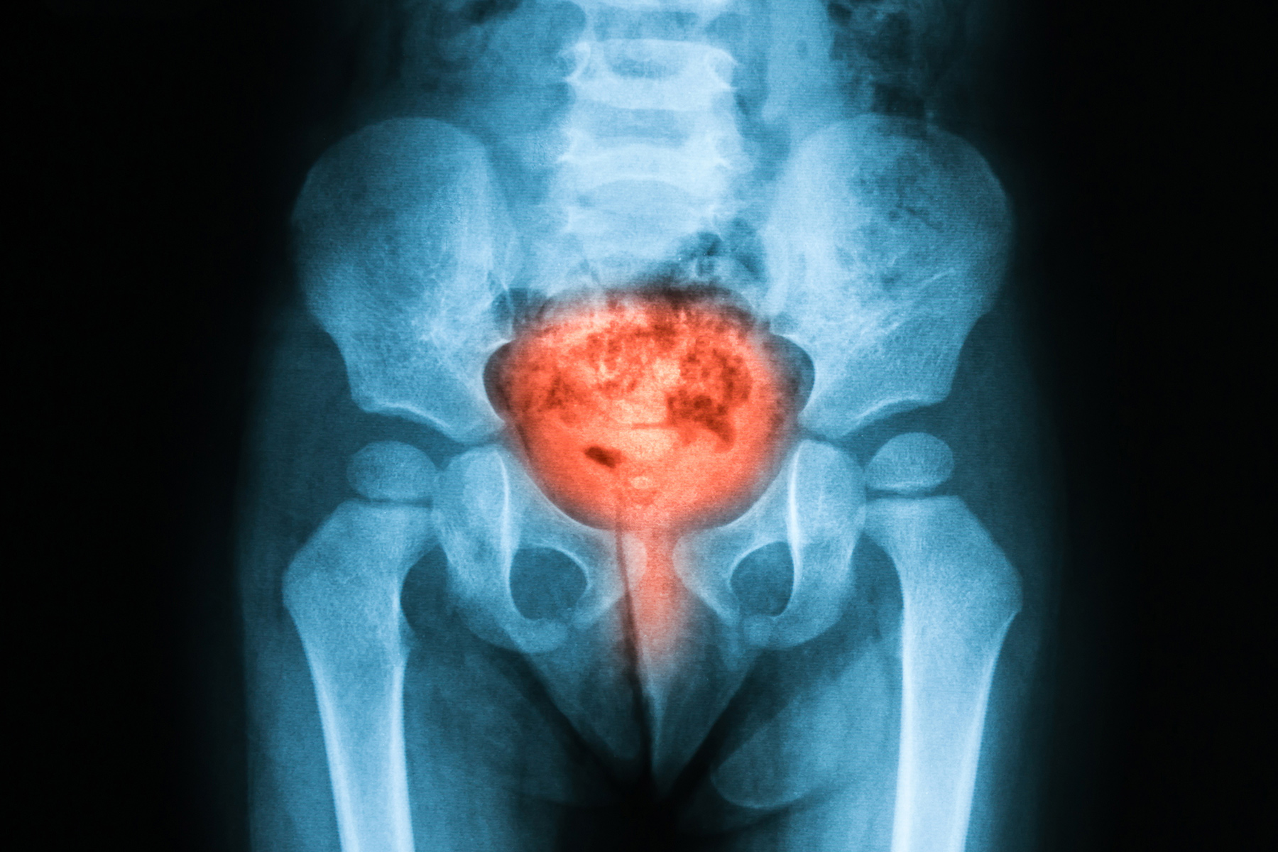 尿频，17种可能