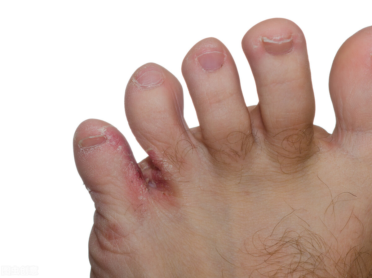 脚气足癣怎么治疗,脚气足癣能治愈吗