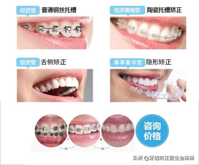 钢牙套矫正的全过程,牙齿稀疏矫正适合隐形还是钢牙套