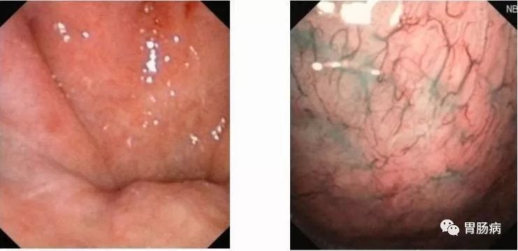 最高端的胶囊胃镜是什么技术,胶囊胃镜的基本工作原理